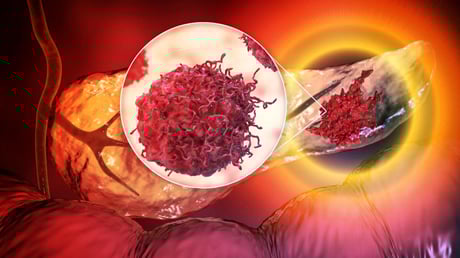 Egy vérteszt áttörést hozhat a hasnyálmirigyrák korai felismerésében