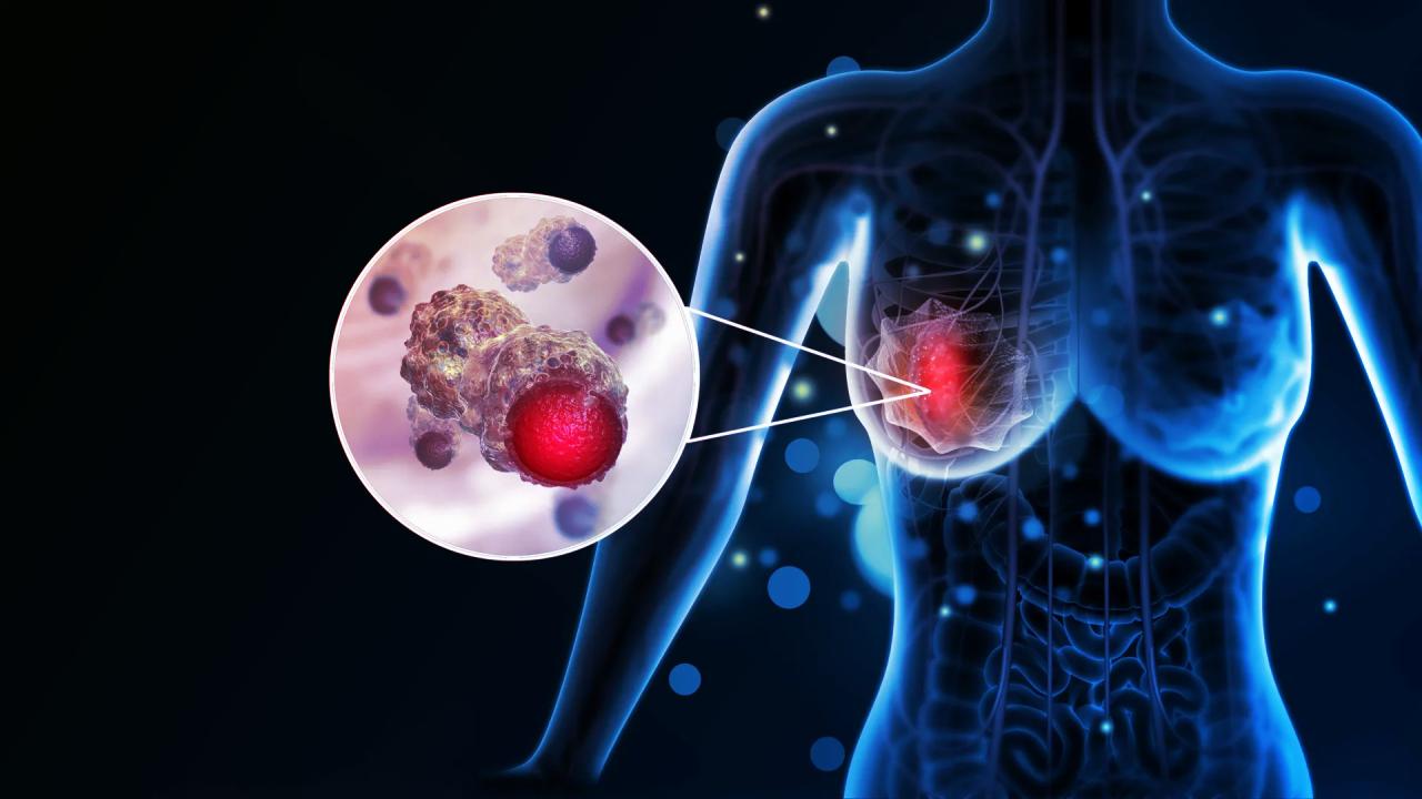 Az agresszív mellrák titka: így némítja el az immunrendszert