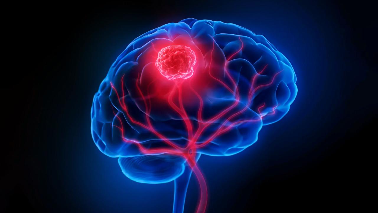 Az agydaganat Achilles-sarka: rejtőző sejtek hajtják a terjedést