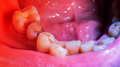 Az áttörés: cukornádból készült műnyál állíthatja meg a fogszuvasodást