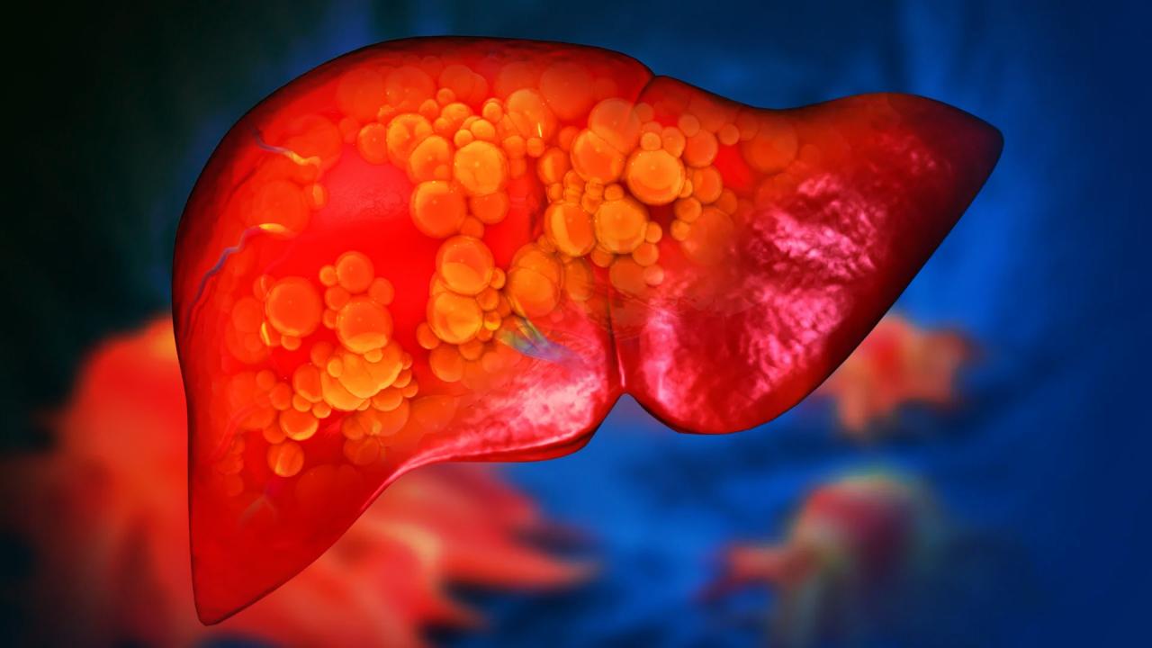 Az egyszeri nagyivás is súlyosan károsíthatja a májat