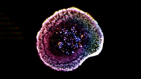 Az első 3D-s felvétel, ahogy T-sejtek leszámolnak a rákkal