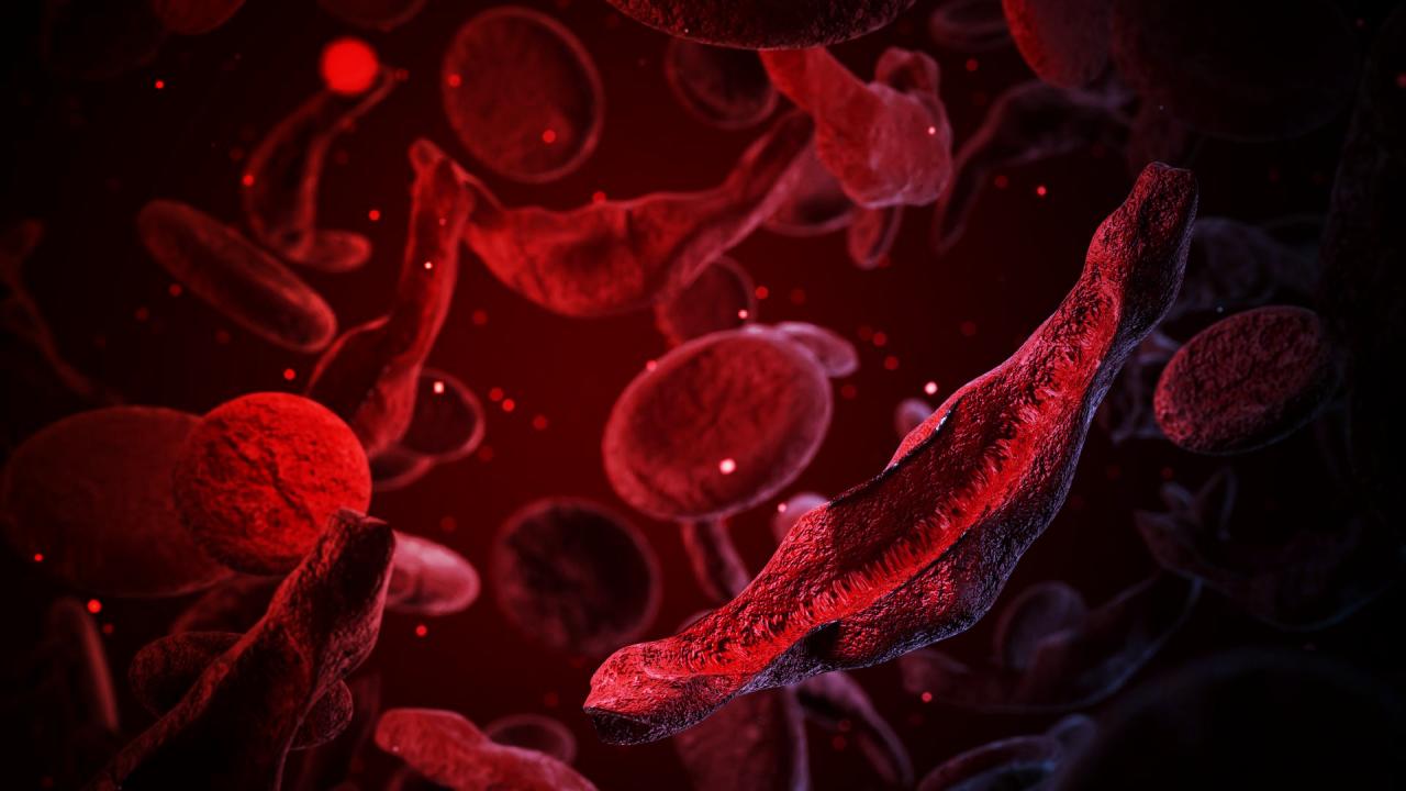 Az első génszerkesztett vérbetegség-kezelés milliós díjat nyert