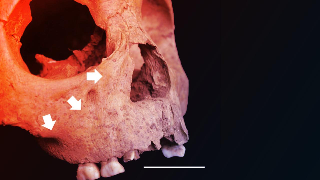 Az őskori vietnámi gyerekfogak őrzik a szifilisz titkos eredetét?