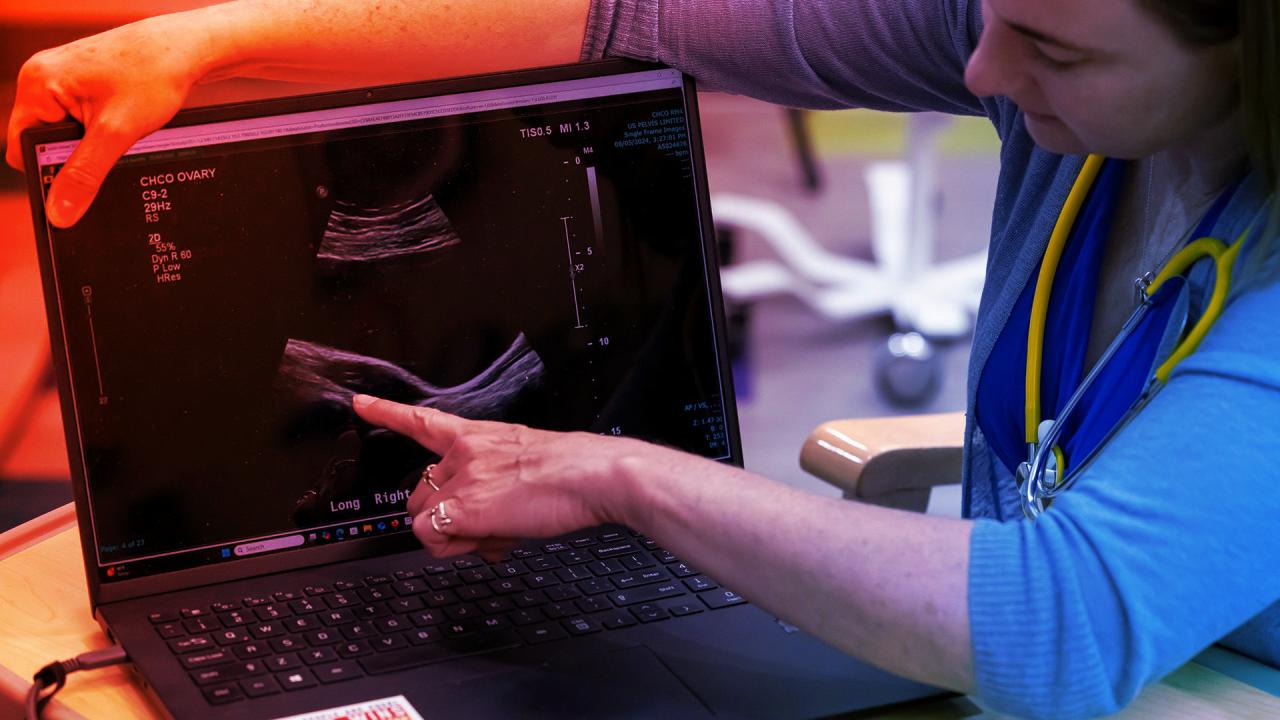 A PCOS valódi arca: hormonvihar a női szervezetben