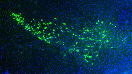 A Yale kutatói megfejthették a Parkinson-kór terjedésének módját