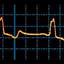Az MI rejtett szívkockázati jelre bukkant a százéves EKG-ban