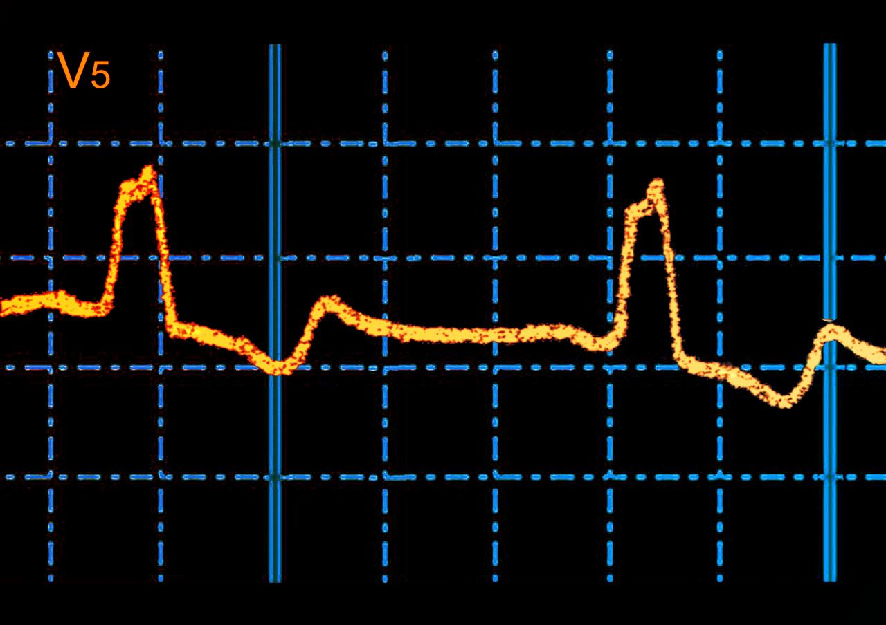Az MI rejtett szívkockázati jelre bukkant a százéves EKG-ban