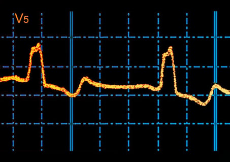 Az MI rejtett szívkockázati jelre bukkant a százéves EKG-ban