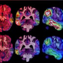 Az új Alzheimer-gyógyszer felforgatja a megszokott kezeléseket