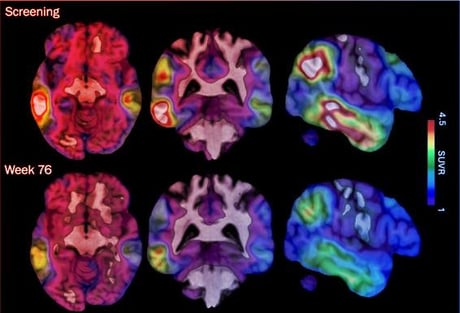 Az új Alzheimer-gyógyszer felforgatja a megszokott kezeléseket