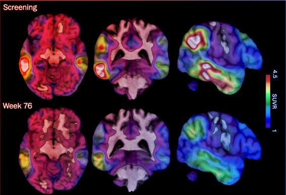 Az új Alzheimer-gyógyszer felforgatja a megszokott kezeléseket