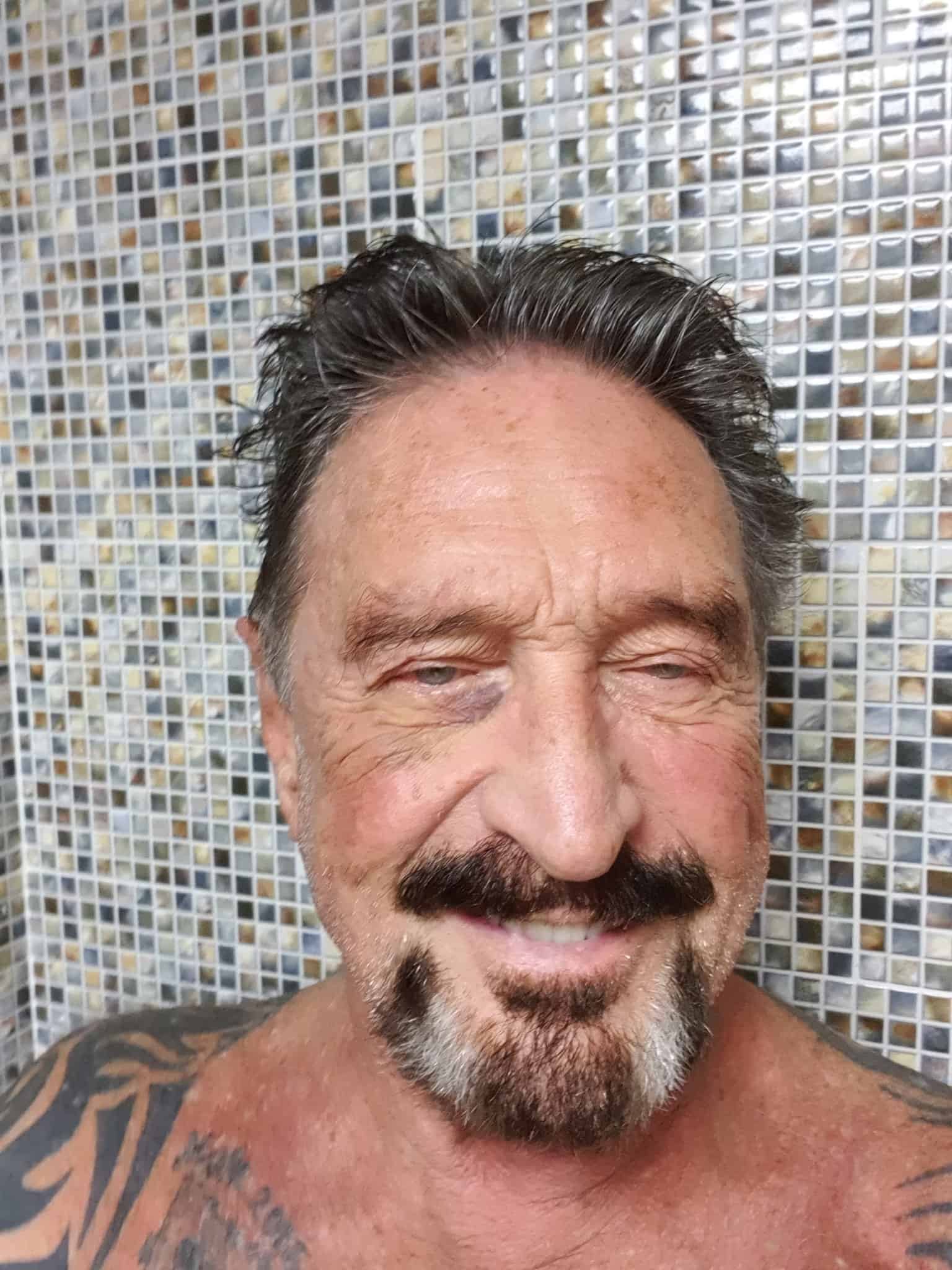 John McAfee Black Eye After Arrest. Source: Twitter