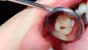 Diş Dolgusu Nedir? Hangi Türleri Vardır?