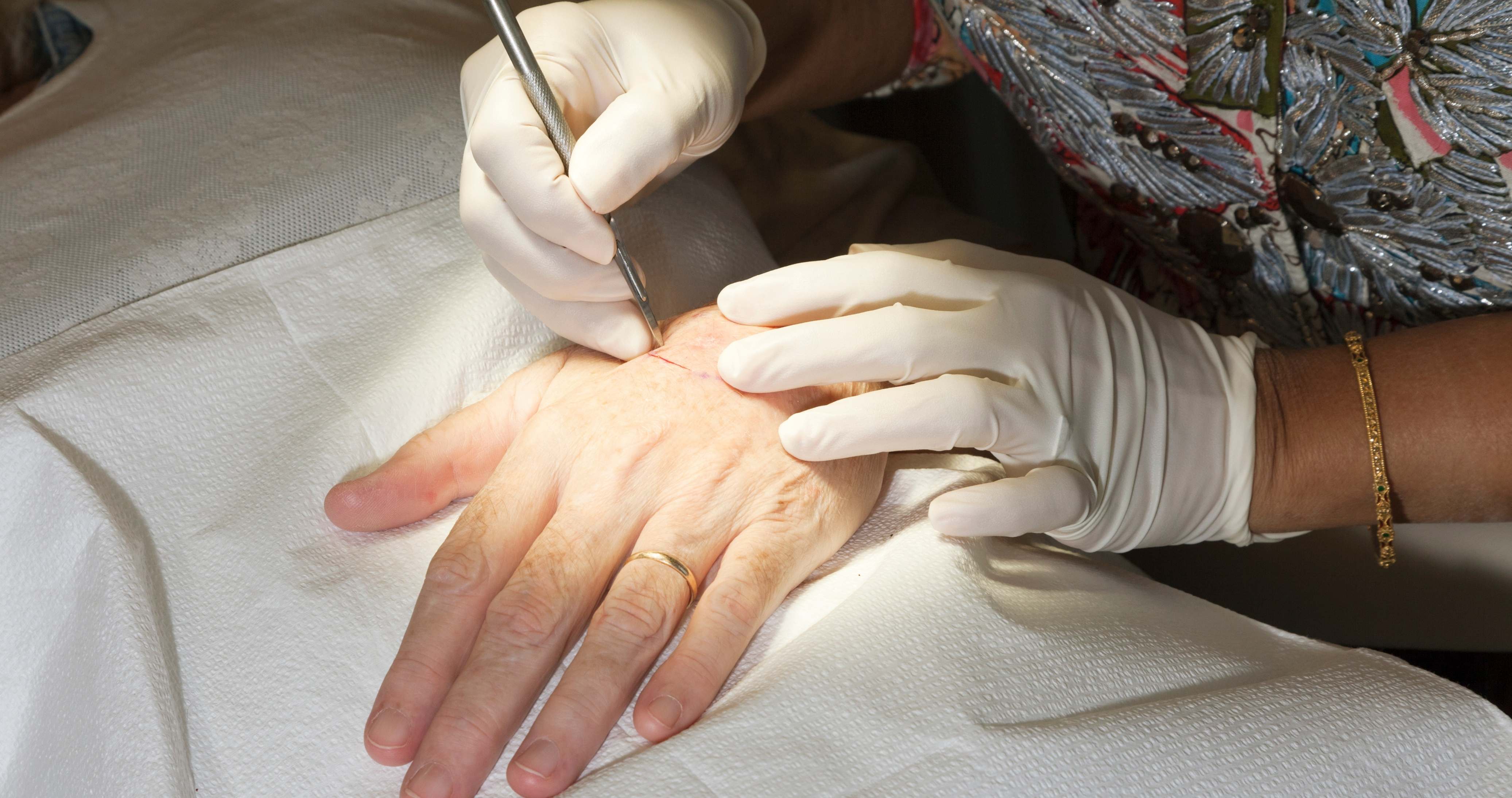 Evde Kesi Süturasyonu