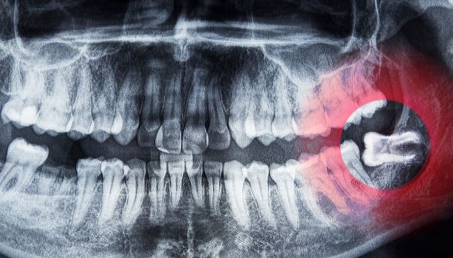 yirmi yaş dişi, yirmi yaş dişi çekimi, gömülü diş, gömülü diş çekimi, üçüncü azı dişi, cerrahi diş çekimi, 20’lik diş, ağız ve diş sağlığı, çekim sonrası bakım, çene cerrahisi, diş eti iltihabı, diş ağrısı, şişlik, ağız hijyeni, sedasyon, anestezi, kuru soket, diş çekimi riskleri, iyileşme süreci, ortodontik bozulma, yirmi yaş diş çekimi sonrası