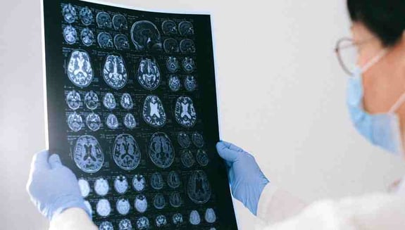 beyin tümörü, dünya beyin tümörü günü, beyin tümörü belirtileri, baş ağrısı, nörolojik belirtiler, beyin ve sinir cerrahisi, online doktor, nöroşirürji