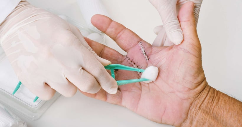 Home Suture Removal 