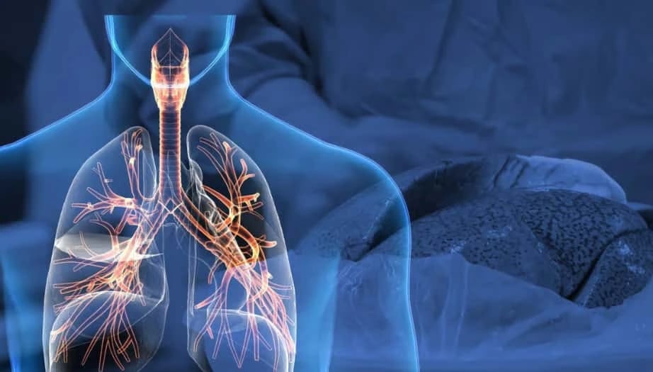 Akciğer Tutulumu Nasıl Geçer? Nedenleri, Belirtileri ve Tedavisi