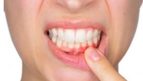 ağız iltihabı, stomatit, ağız yarası tedavisi, ağız içi enfeksiyon, ağız bakımı, vitamin eksikliği, ağız içi iltihap