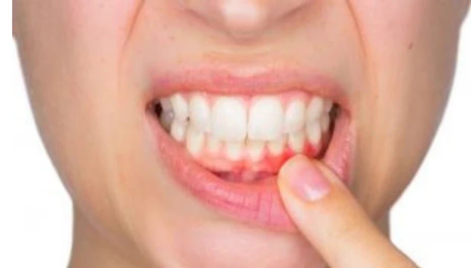 Ağız İltihabı Nedir? Belirtileri ve Tedavisi