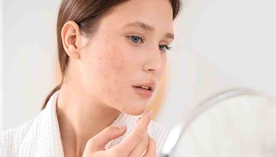 Sivilce Ve Cilt Problemleri İçin Check-Up’ta Hangi Hormon Testleri İstenir?
