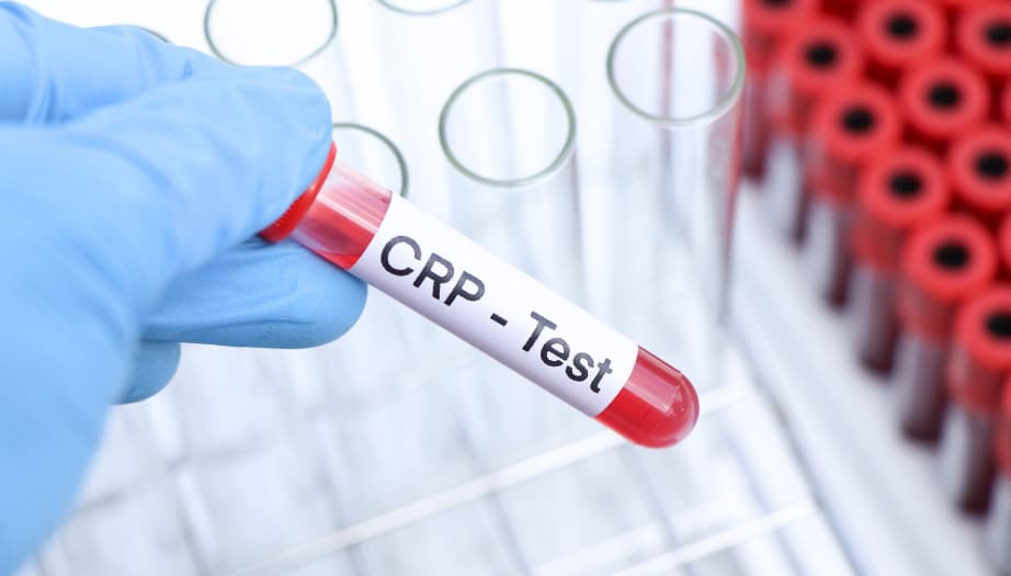 CRP Nedir? CRP Yüksekliği Ne Anlama Gelir?