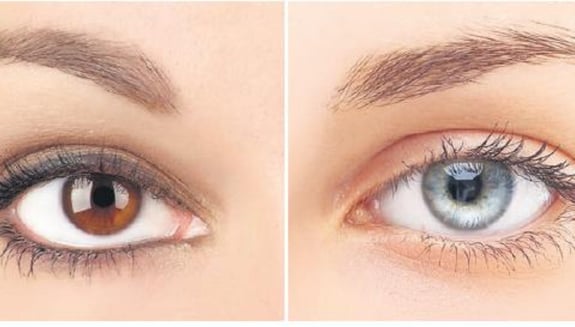 göz rengi değiştirme, lazerle göz rengi açma, iris implantasyonu, göz sağlığı, estetik ameliyat, göz rengi değişikliği, renkli kontakt lens, göz ameliyatı riskleri, göz sağlığına zarar, estetik göz ameliyatı