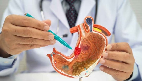 mide kanseri, mide kanseri belirtileri, mide kanseri taraması, endoskopi, gastroskopi, helicobacter pylori, mide check up, sindirim sistemi paketi, kanser taraması, happ health