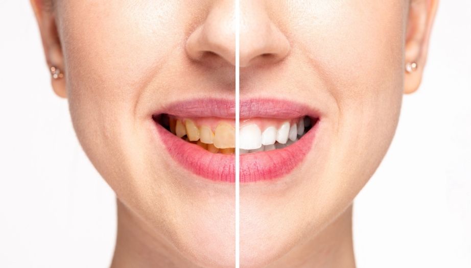 diş beyazlatma, diş beyazlatma nasıl yapılır, diş beyazlatma ne kadar, diş beyazlatma zararlı mı, diş beyazlatma ne kadar kalıcı, diş beyazlatma ne kadar sürer, diş beyazlatma acıtır mı, diş beyazlatma sağlıklı mı, diş beyazlatma kaç seans, diş beyazlatma işlemi nasıl yapılır, diş beyazlatma işlemi ne kadar sürer, diş beyazlatma kalıcı mı, diş beyazlatma diş minesine zarar verir mi, aktif karbon diş beyazlatma tozu zararlı mı, diş beyazlatma tozu zararlı mı, diş beyazlatma tozu nasıl kullanılır, devlette diş beyazlatma var mı