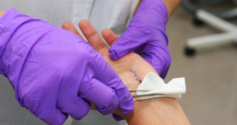 Home Suturing and Suture Removal 