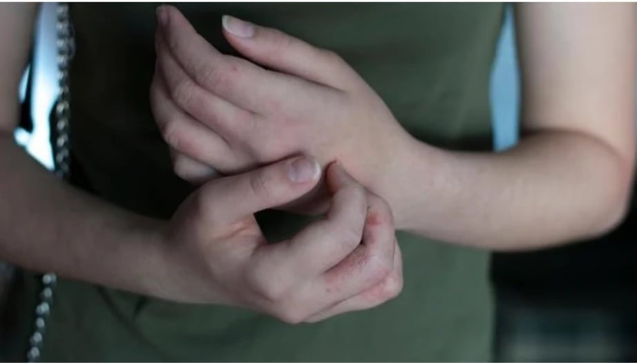 uyuz belirtileri, uyuz, uyuz tedavisi, vajinada uyuz belirtileri, uyuz başlangıcı, uyuz losyonu, uyuz döküntüsü, uyuz salgını, uyuz hastalığı, uyuz hastalığı belirtileri, uyuz hastalığı tedavisi, uyuz hastalığı ilaçları, uyuz hastalığı böceği, uyuz hastalığına kesin çözüm, uyuz hastalığına bitkisel çözüm