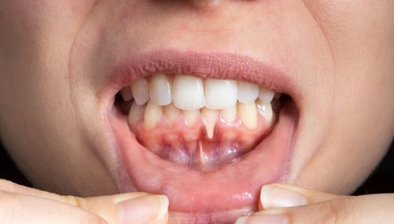diş eti çekilmesi, diş eti çekilmesi tedavisi, periodontoloji, diş eti hastalıkları, diş eti grefti, gingival resesyon, periodontal tedavi, diş hassasiyeti, diş eti kanaması, diş eti iltihabı