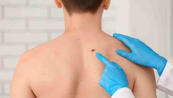 cilt kanseri, cilt kanseri farkındalık ayı, ben takibi, ABCDE kuralı, melanom, güneşten korunma, online doktor