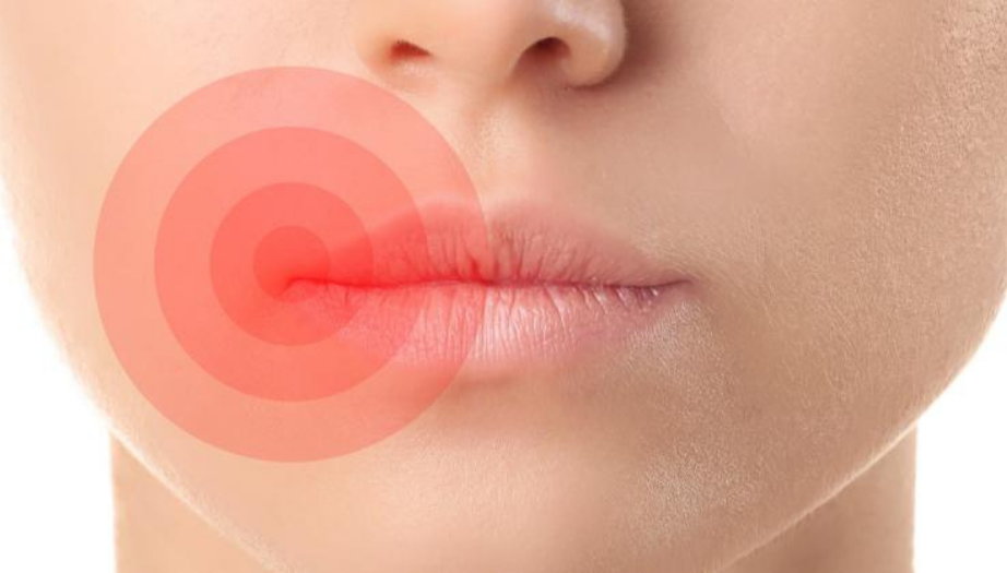 dudak iltihabı, cheilitis, dudak iltihabı tedavisi, dudak iltihabı nedenleri, dudak bakım, alerjik reaksiyon, dudak çatlaması, dudak kuruması, dudak sağlığı, dudak iltihabından korunma