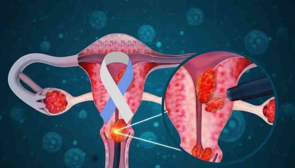 rahim ağzı kanseri, serviks kanseri, rahim ağzı kanseri belirtileri, rahim ağzı kanseri nedenleri, serviks kanseri tedavisi, hpv ve rahim ağzı kanseri, smear testi, hpv aşısı, kadın sağlığı, jinekoloji, happ health