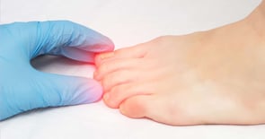 Home Nail Removal and Nail Bed Revision