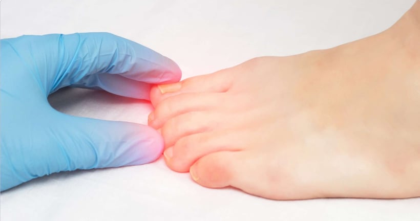 Home Nail Removal and Nail Bed Revision