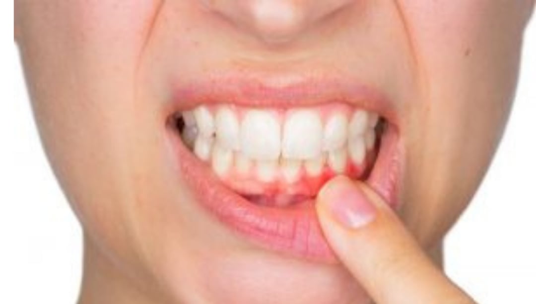 Ağız İltihabı Nedir? Belirtileri ve Tedavisi