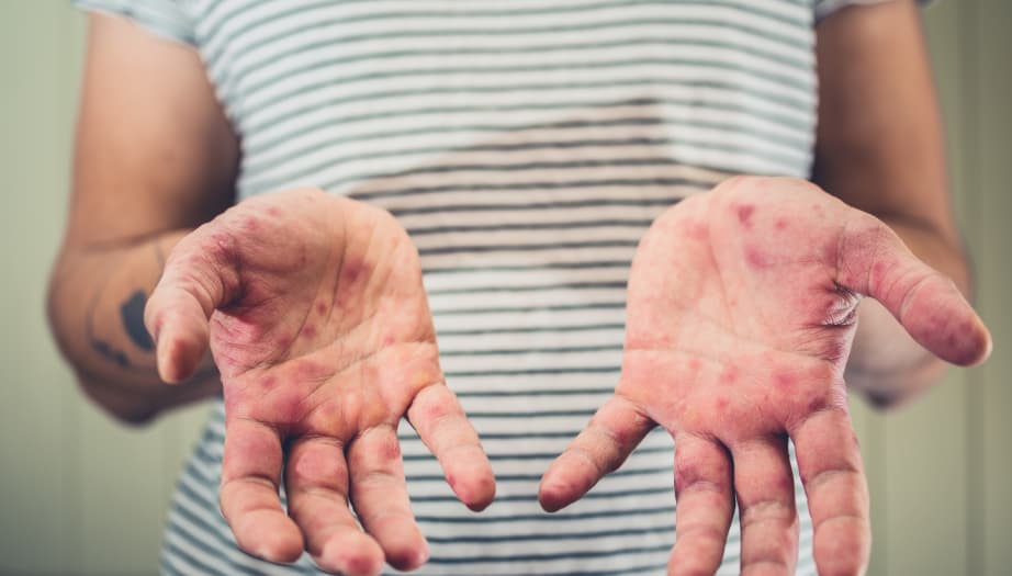 el ayak ağız hastalığı, el ayak ağız hastalığı belirtileri, el ayak hastalığı ağız içi, el ağız ayak hastalığı, ağız içi el ayak hastalığı başlangıç, el ayak ağız hastalığı tedavisi