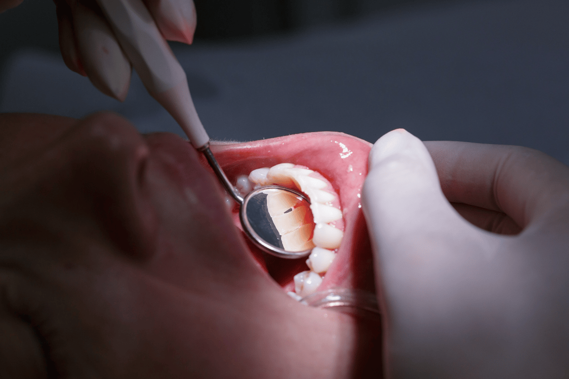 Periodontitis, una de las patologías más comunes en personas de edad avanzada – Over Karma