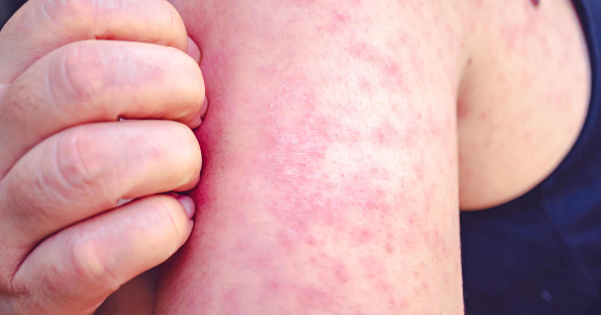 Photo of Measles cases rose 79% globally last year, WHO says. Experts explain why.