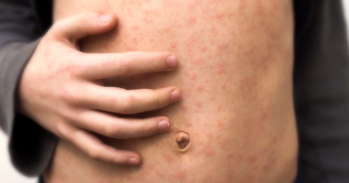 Identifying Measles Rash Symptoms as Virus Spreads in US – The Daily Guardia