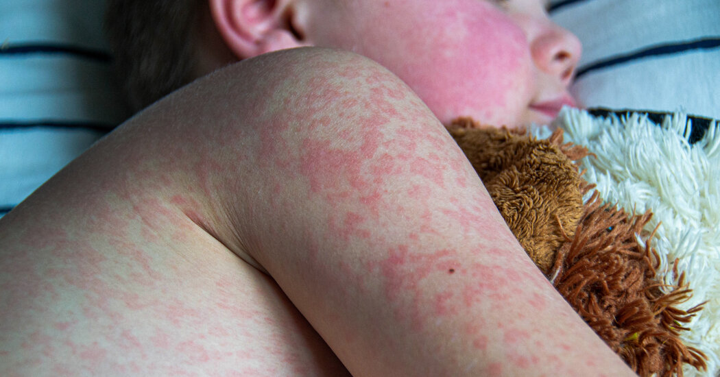 U.S. Measles Cases Surpass 2023 Levels, C.D.C. Says – The Daily Guardian
