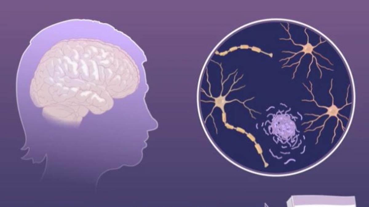 Alzheimer, i cambiamenti silenziosi nel cervello che precedono la malattia (fino a 18 anni prima della perdita di memoria)