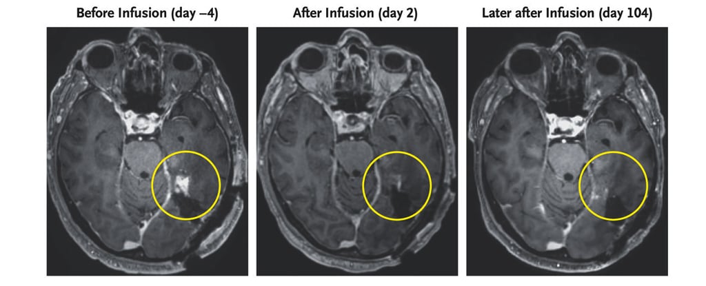 Groundbreaking Treatment Eradicates Lethal Brain Tumor in Record Time