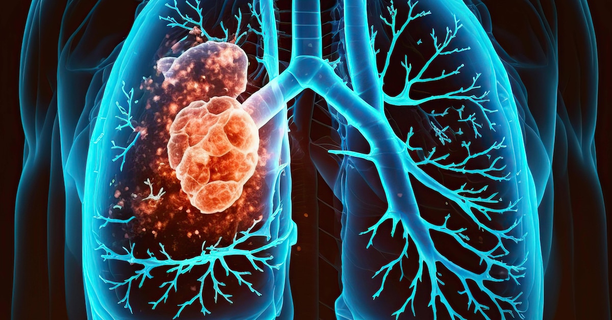 Blut in der Lunge: Ursachen und Symptome erklärt