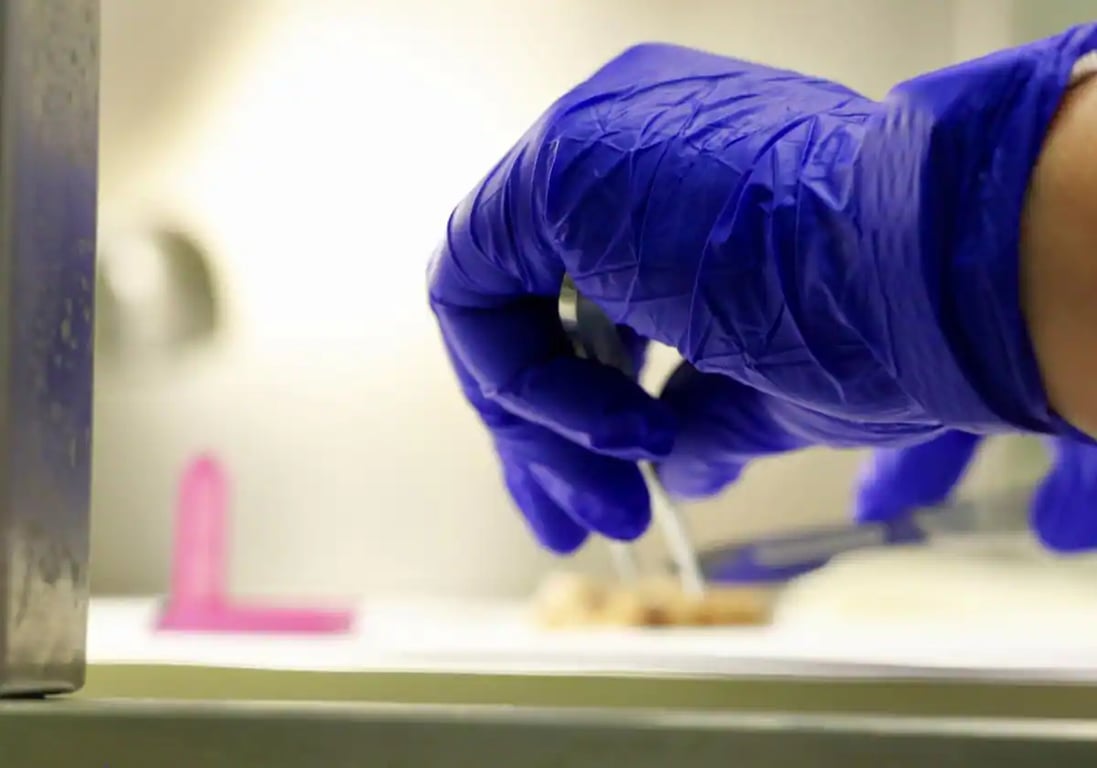 Detectan hemorragias cerebrales en pacientes con implantes de cadáveres – Deporticos
