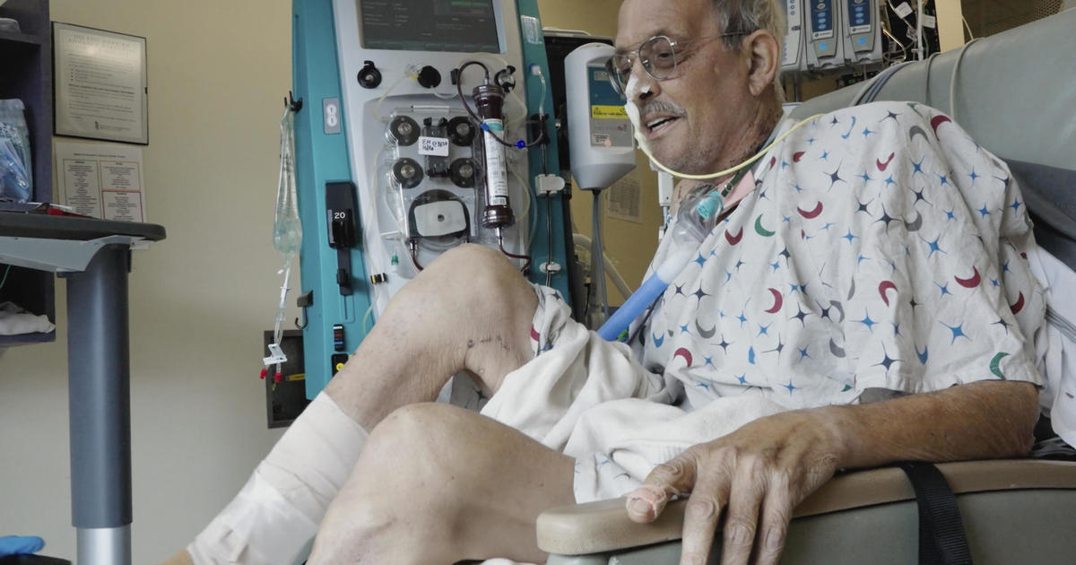 Photo of Maryland Man Persevering Through Challenging Physical Therapy After Pig Heart Transplant