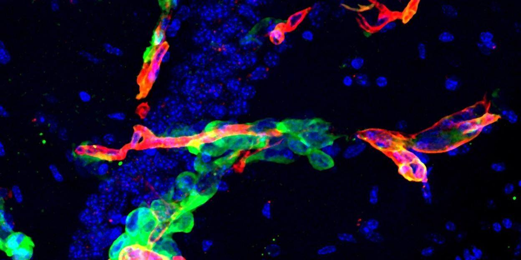 ¿Por qué algunas células hacen metástasis en el cáncer y otras no? Un estudio lo explica – Oncenoticias